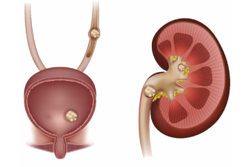 Kidney Stone Disease