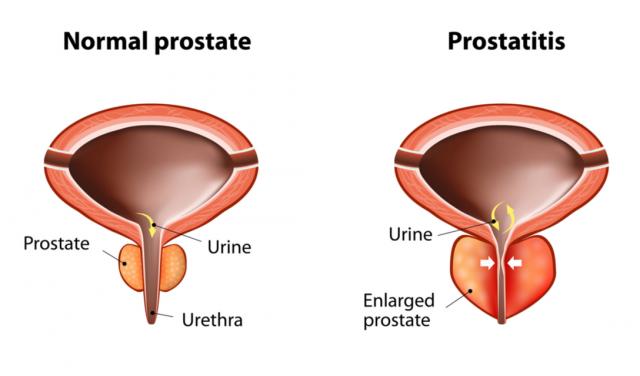 Prostate Surgery