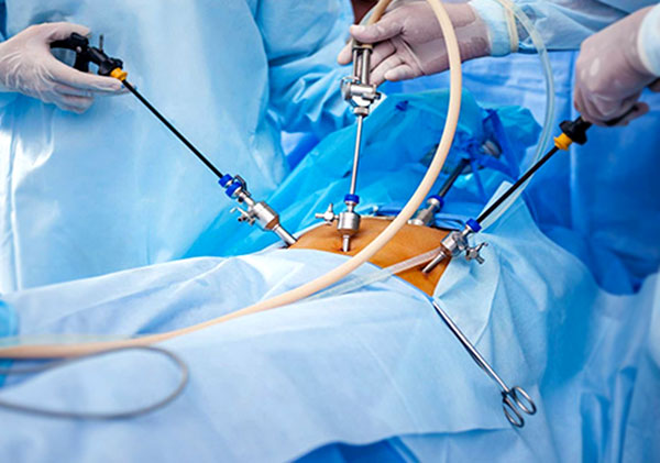 Laparoscopic Procedures