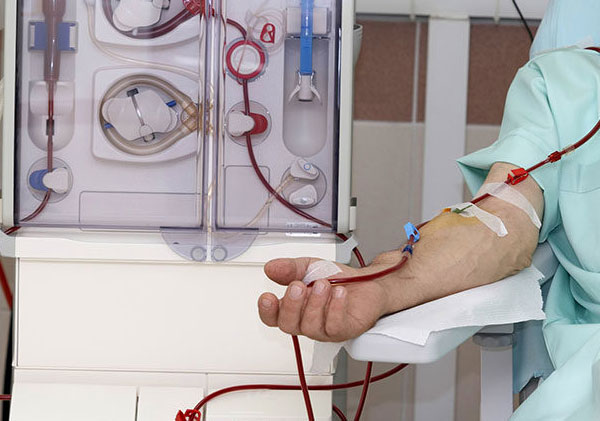 Vascular Access For Dialysis