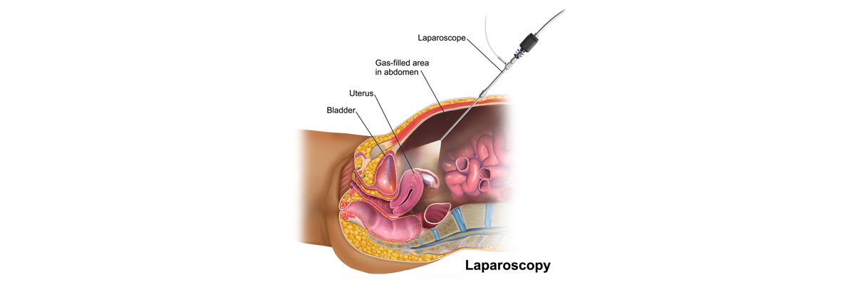 Laparoscopic Surgery